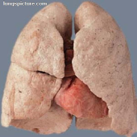 Medicare Loses $9 Million a Year by Counting Two Donated Lungs as One