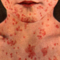 Measles Outbreak at Disneyland and Elsewhere Blamed on Foreign Visitors and Anti-Vaccine Movement