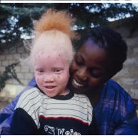 Thousands of African Albinos Hide to Avoid Body-Parts Hunters