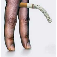 Surgeon General Report Accuses Cigarette Smoking of Causing Diabetes, Arthritis and Erectile Dysfunction