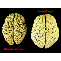 Astronauts May Contract Alzheimer’s Disease from Deep Space Travel