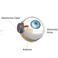 FDA Set to Approve First Bionic Eye