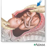 Caesarean Births in U.S. Hit All-Time High