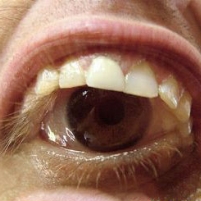 Miami Doctors Use Tooth to Restore Woman’s Sight