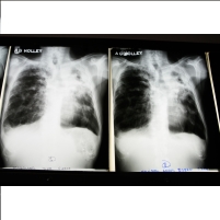 Florida Officials Kept Secret Worst TB Outbreak in 20 Years as Leading TB Hospital Closed to Save Money