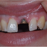Eating Can be Dangerous to Your Teeth