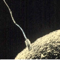 Family Sues Sperm Bank for Bad Sperm