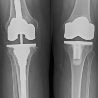 Most Popular Surgery Thanks to Obamacare: Knee Replacements
