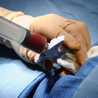 Legalize the Selling of Bone Marrow: Steve Chapman