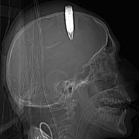 Surgeon Removes Live Explosive from Afghan Soldier’s Head
